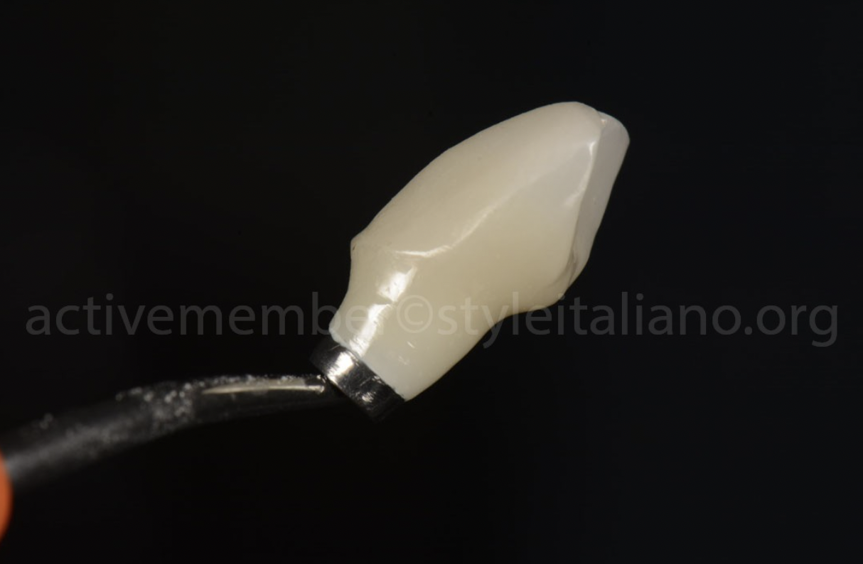 Phục hình thẩm mỹ răng cửa bằng sự kết hợp giữa Veneer và implant